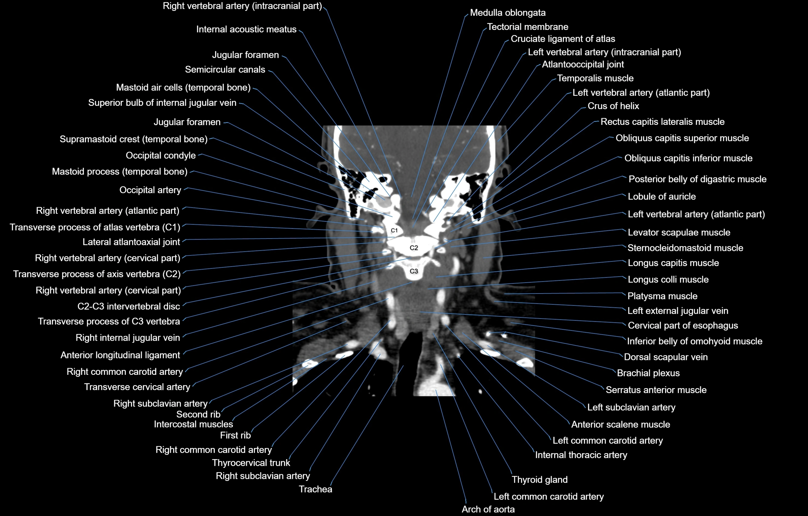 CT Neck coronal  cross sectional anatomy labelled 3D  radiology  image-00040.webp